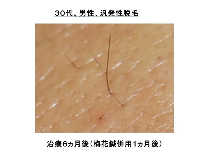 円形脱毛症　病院